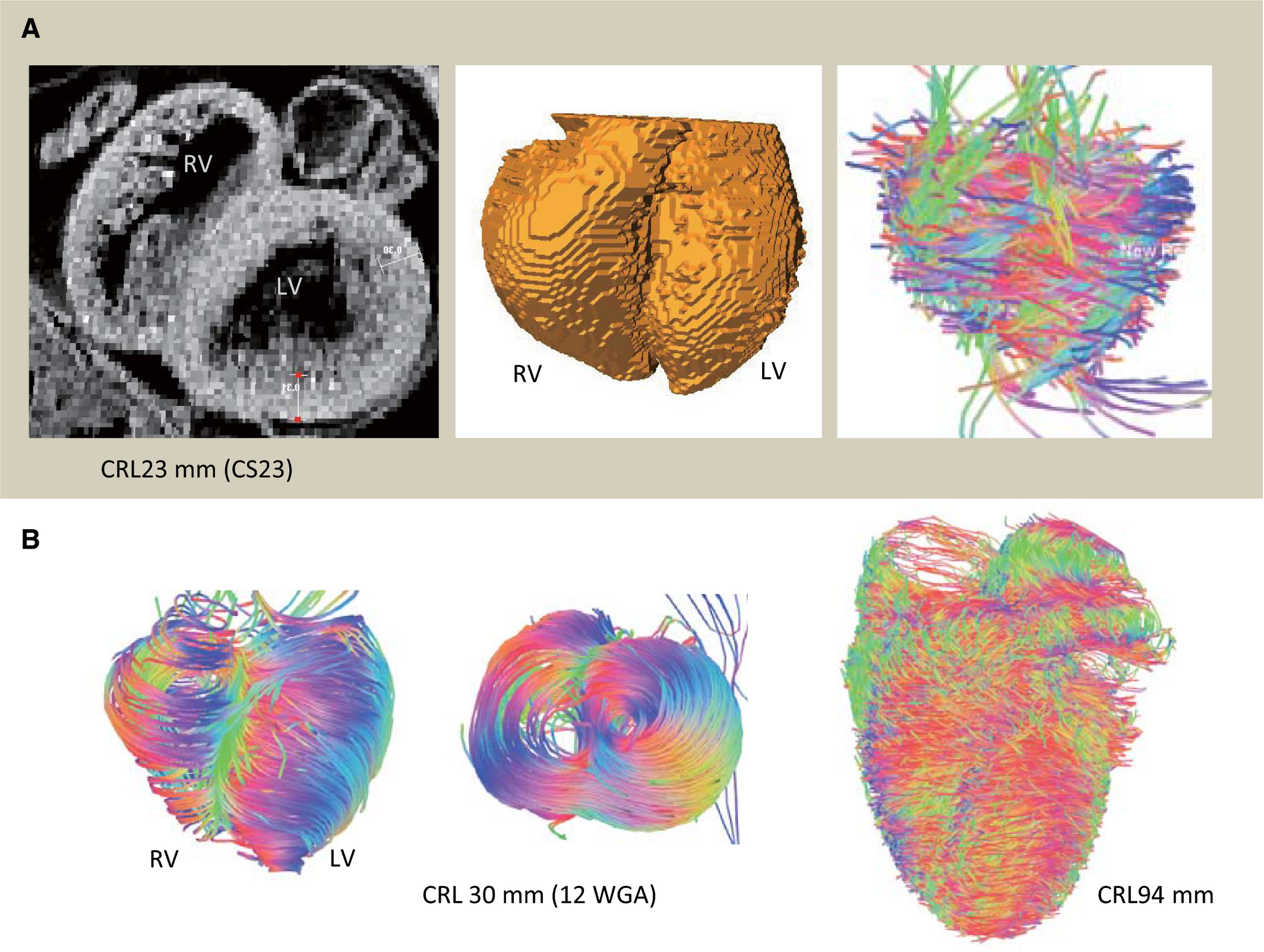 研究紹介：胎児心筋走向のMRI画像解析